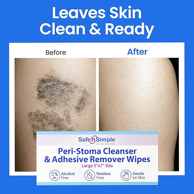 Safe n’ Simple Adhesive Remover for Skin - 75 Individually Wrapped 5"x7" Sting Free Alcohol Free Medical Adhesive Remover Wipes - Gentle Stoma & Ostomy Adhesive Removal Pads for Sensitive Skin