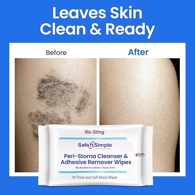 Safe n’ Simple Resealable Adhesive Remover Wipes for Skin - 50 Large 5"x7" No Sting Alcohol Free Medical Adhesive Remover Pads for Ostomy, Stoma Care - Gentle Adhesive Removal Wipes for Bandages, Tape