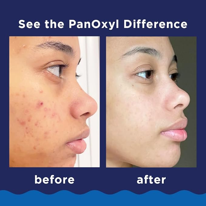 PanOxyl Acne Foaming Wash Benzoyl Peroxide 10% Maximum Strength Antimicrobial, 5.5 Oz (Pack of 2)