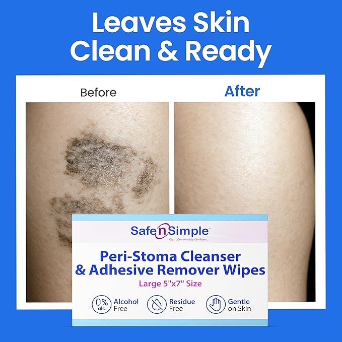 Safe n' Simple Adhesive Remover for Skin - 5"x7" 50 Wipes - Stoma Adhesive Remover Wipes - Alcohol Free Wipes for Sensitive Skin - No Sting Adhesive Remover Wipes